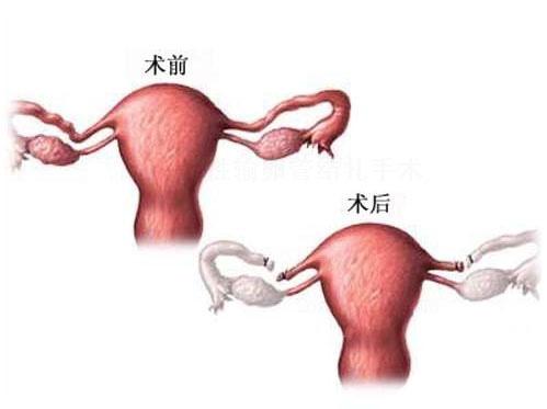 女性结扎手术图片(女性结扎手术全过程（附图）)