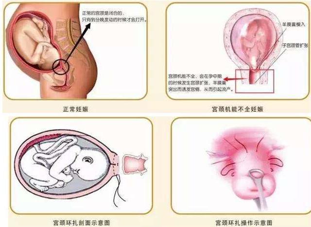 将胎儿塞回子宫(孕妇先兆流产，医生将胎儿塞回子宫，这样真能“保胎”吗？)
