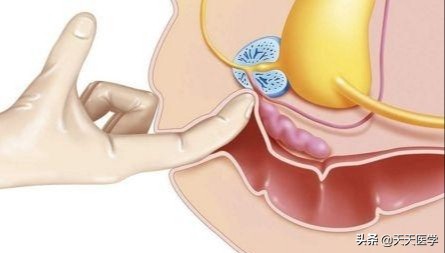 前列腺检查是什么？
