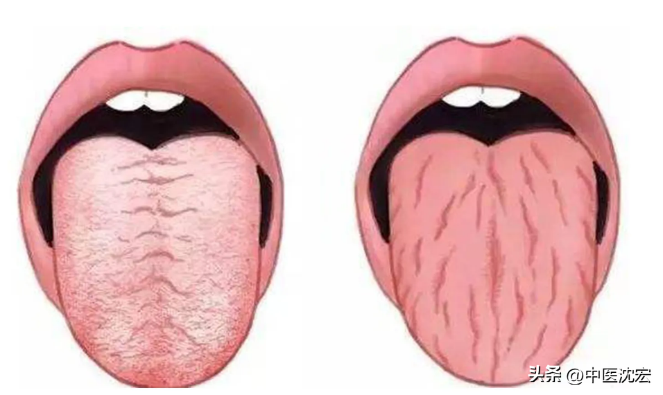 舌头裂纹(舌头有裂纹？可能是脾虚，2味药，一补一泄，健脾祛湿 赶跑裂纹舌)