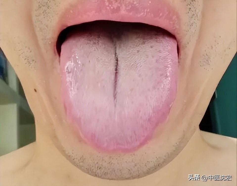 舌头裂纹(舌头有裂纹？可能是脾虚，2味药，一补一泄，健脾祛湿 赶跑裂纹舌)