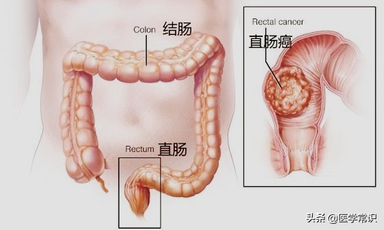直肠癌有什么症状？