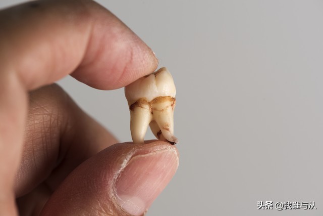 做了根管治疗不做牙冠可以维持多少年？