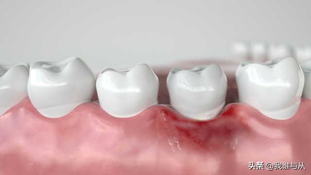 做了根管治疗不做牙冠可以维持多少年？