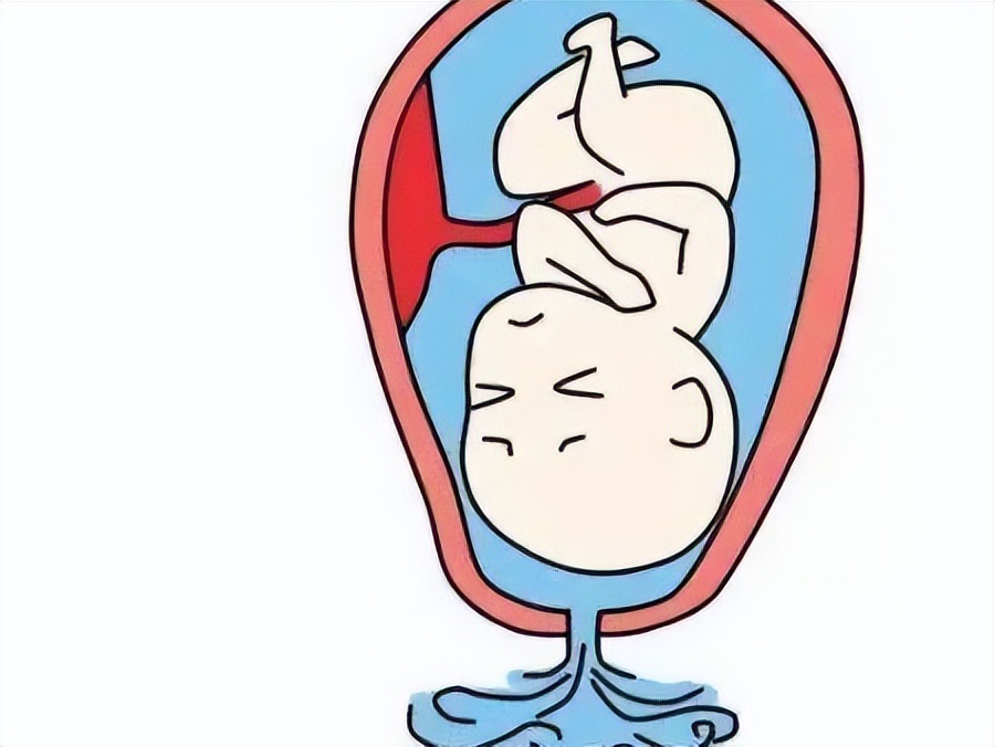 哪些因素会导致胎膜早破？该如何预防？