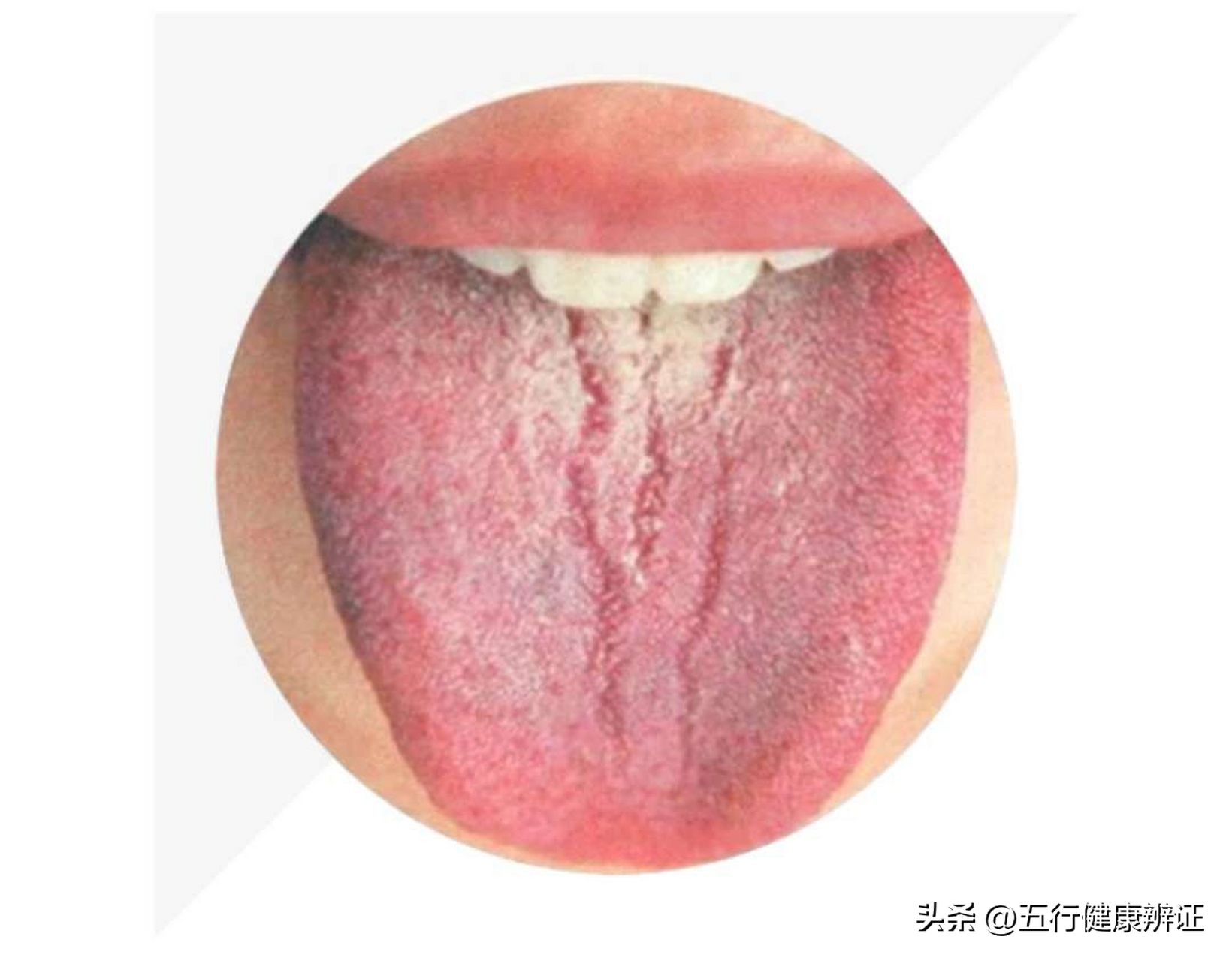 舌中有裂缝是什么原因？