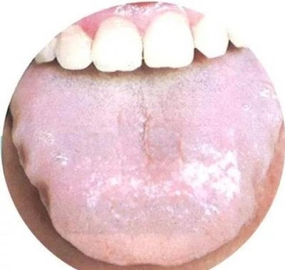 舌中有裂缝是什么原因？