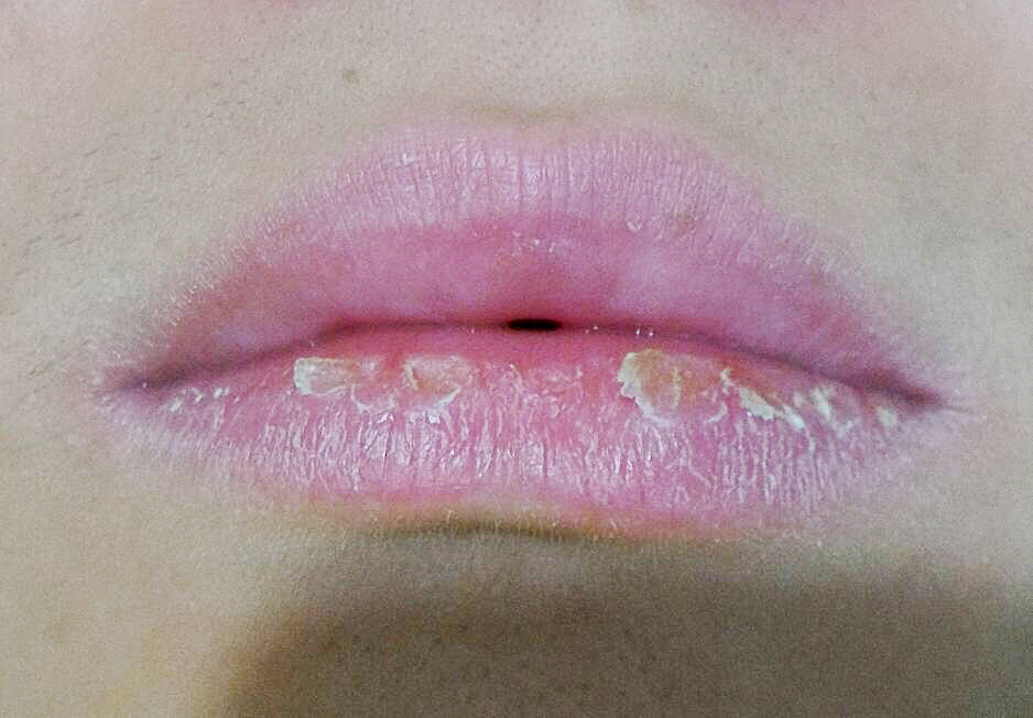 嘴唇干裂脱皮是什么原因引起的？