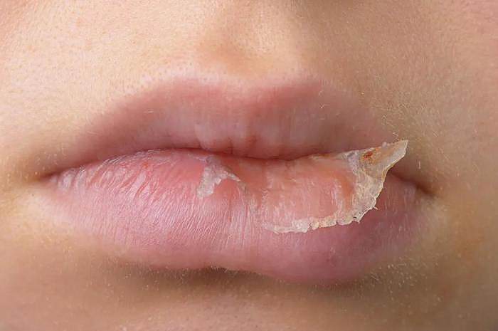 嘴唇干裂脱皮是什么原因引起的？