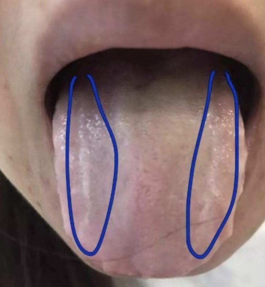 舌头胖大有齿痕，需要怎么调理？
