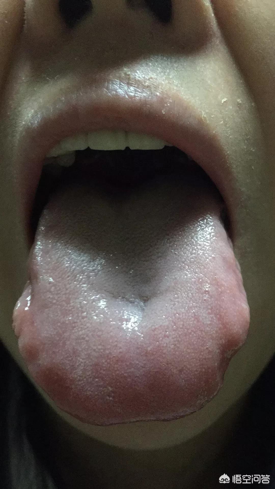 舌头胖大有齿痕，需要怎么调理？