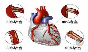 心脏彩超能查出冠状动脉狭窄程度吗？有何依据？