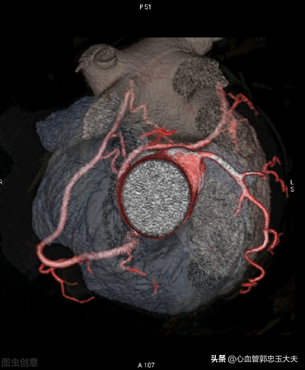 心脏彩超能查出冠状动脉狭窄程度吗？有何依据？