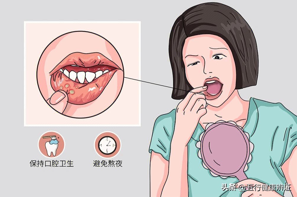 口腔溃疡为何总是好不了？该怎么办？