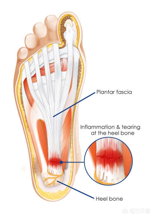 脚底板疼痛是怎么回事？